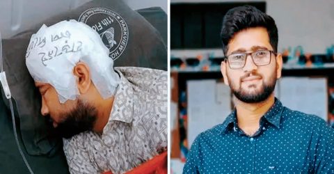 দুই মাস পর চবি শিক্ষার্থী মামুনের মাথার খুলি প্রতিস্থাপন
