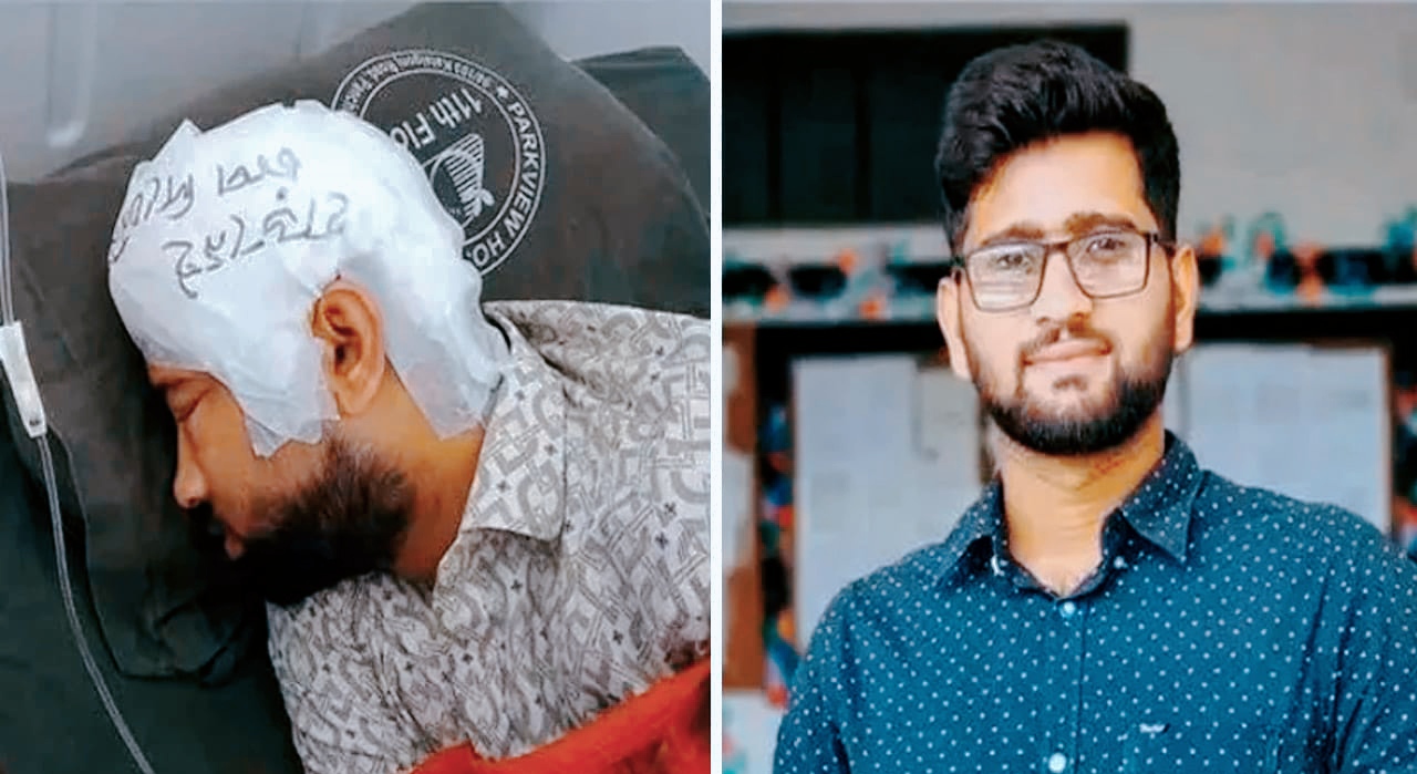 দুই মাস পর চবি শিক্ষার্থী মামুনের মাথার খুলি প্রতিস্থাপন