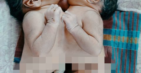 পত্নীতলায় জোড়া লাগানো জমজ নবজাতকের জন্ম