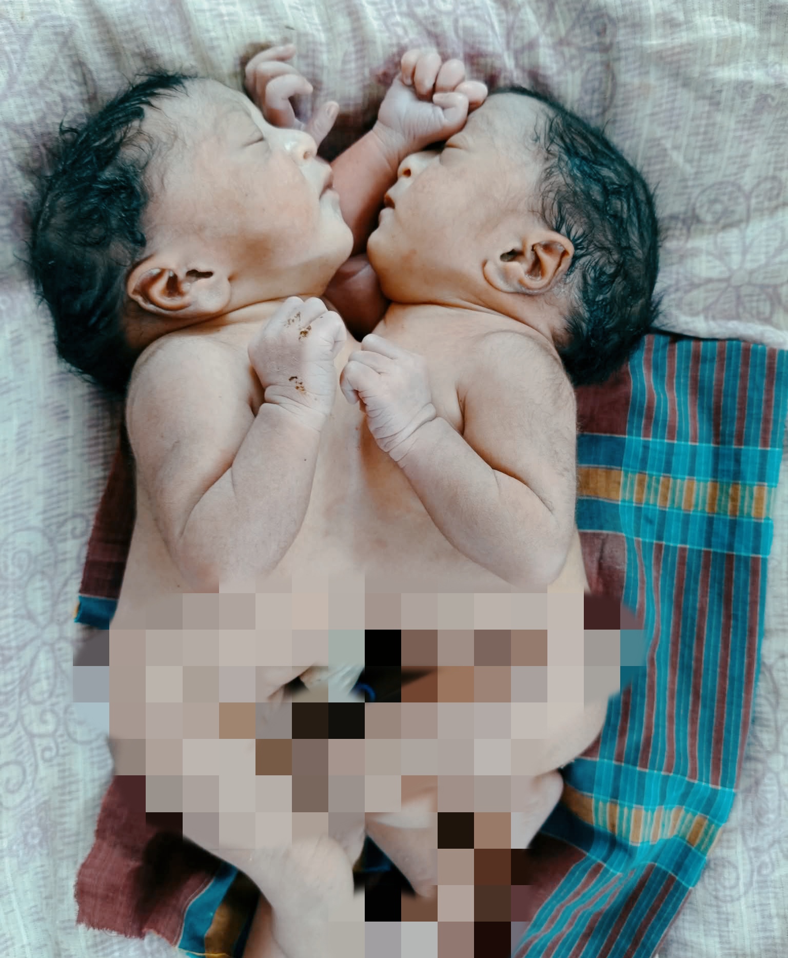 পত্নীতলায় জোড়া লাগানো জমজ নবজাতকের জন্ম